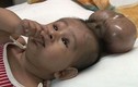 Phẫu thuật thành công em bé có đầu “sinh đôi“